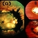 Macular Coloboma